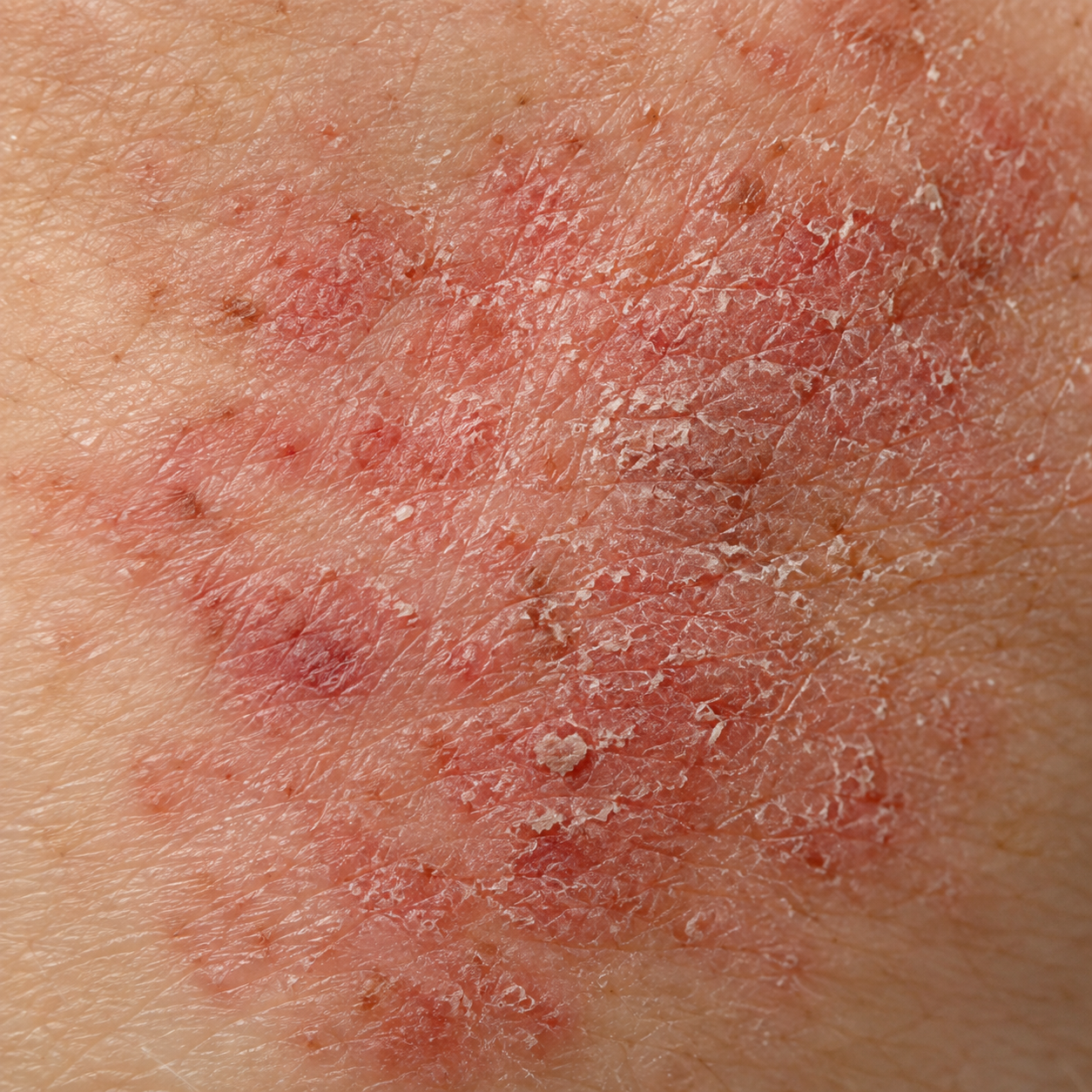 Atopic Dermatitis: When Treatments Cause the Same Symptoms as the Disease